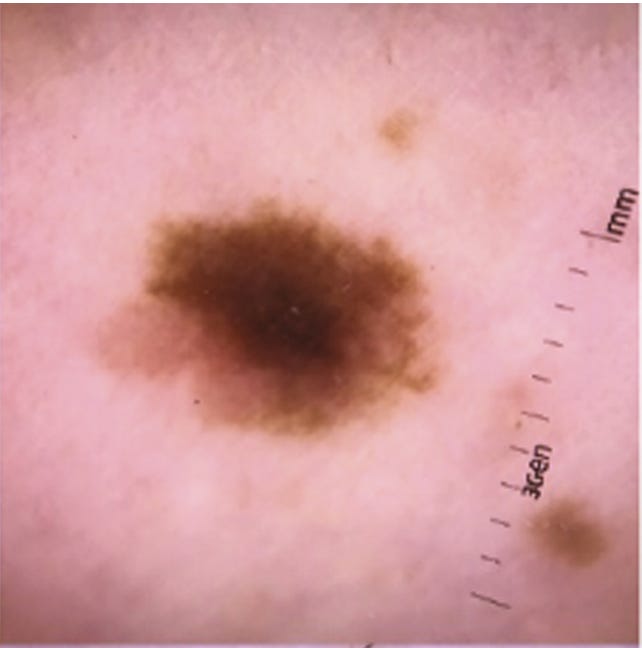 Lesion Image