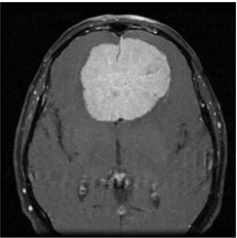 meningioma